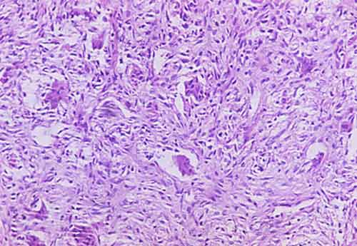 fibroma